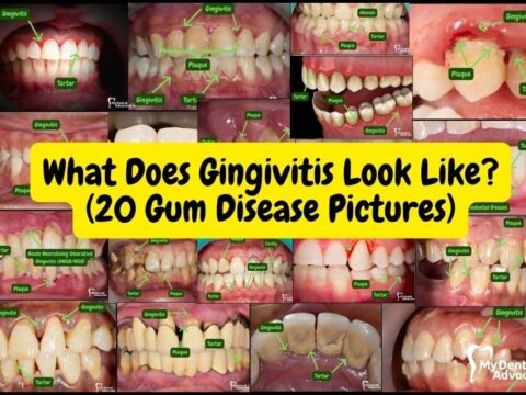 20 gum disease picture